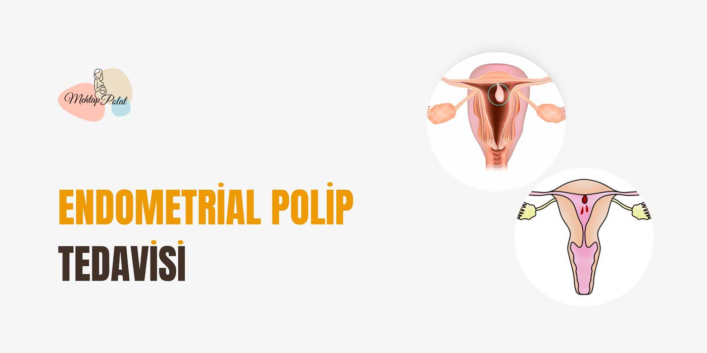 endometrial polip tedavisi